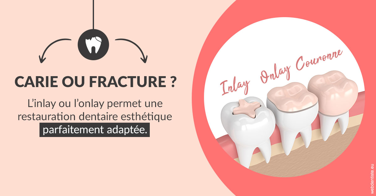 https://dr-baudelot-olivier.chirurgiens-dentistes.fr/T2 2023 - Carie ou fracture 2