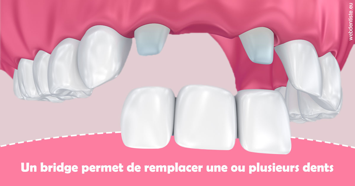 https://dr-baudelot-olivier.chirurgiens-dentistes.fr/Bridge remplacer dents 2