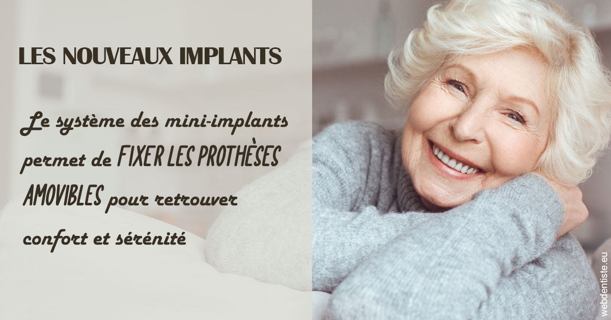 https://dr-baudelot-olivier.chirurgiens-dentistes.fr/Les nouveaux implants 1