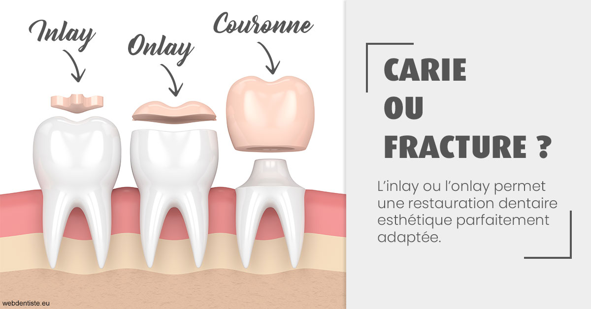 https://dr-baudelot-olivier.chirurgiens-dentistes.fr/T2 2023 - Carie ou fracture 1