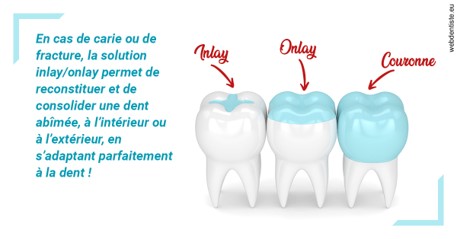https://dr-baudelot-olivier.chirurgiens-dentistes.fr/L'INLAY ou l'ONLAY