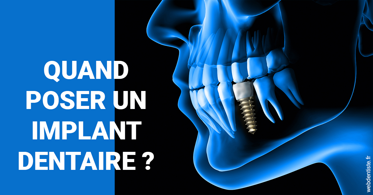 https://dr-baudelot-olivier.chirurgiens-dentistes.fr/Les implants 1