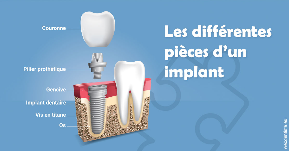 https://dr-baudelot-olivier.chirurgiens-dentistes.fr/Les différentes pièces d’un implant 1