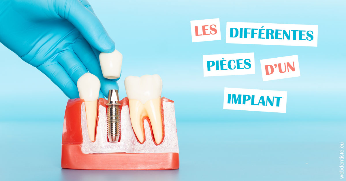 https://dr-baudelot-olivier.chirurgiens-dentistes.fr/Les différentes pièces d’un implant 2